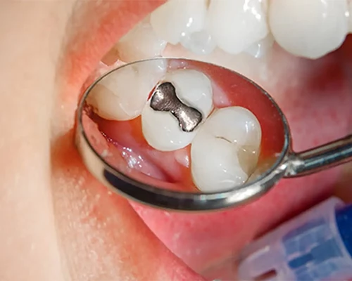 آموزش پر كردن دندان