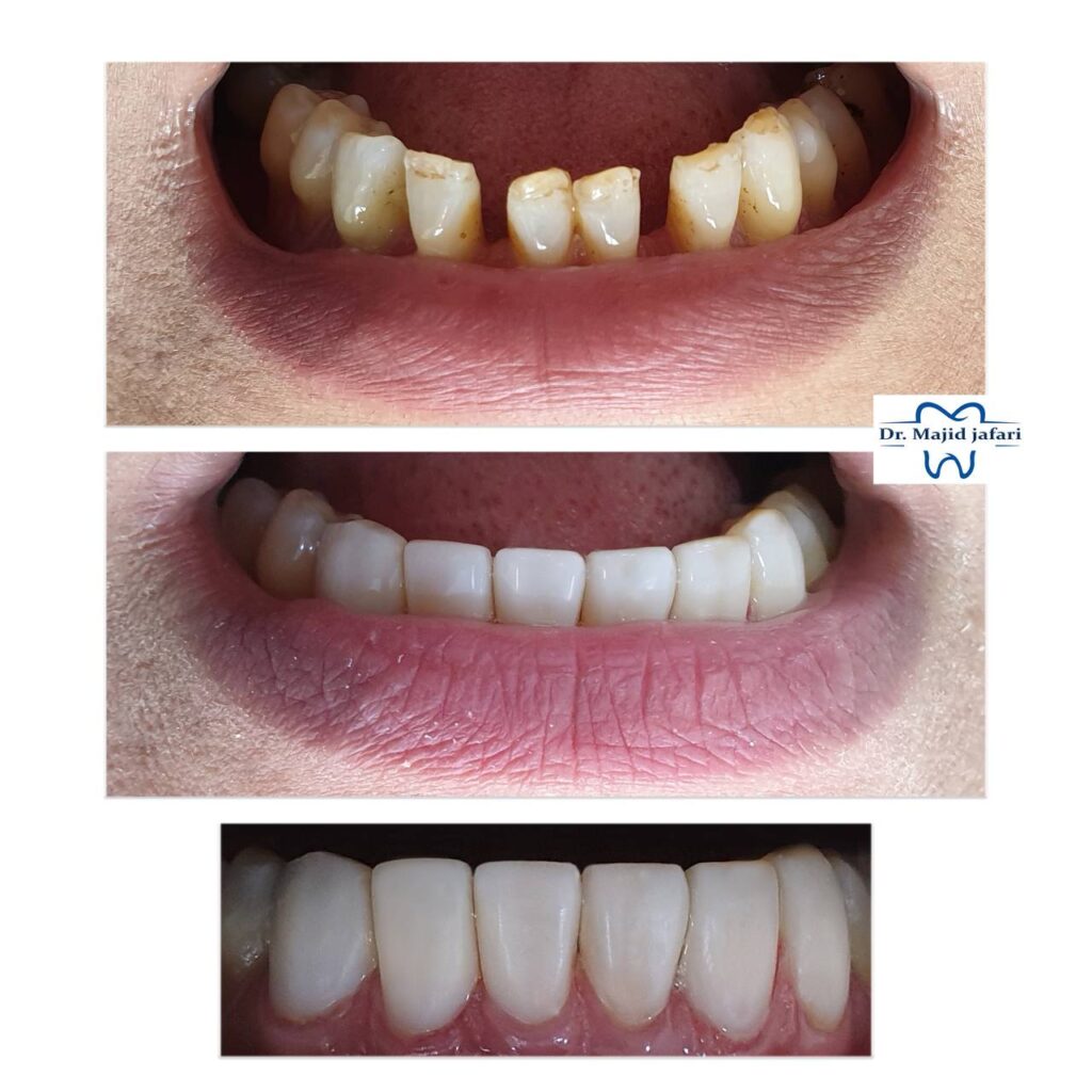 بستن فاصله بین دندانها