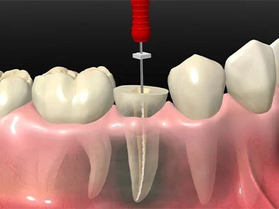 پر کردن دندان جلو بعد از عصب‌کشی
