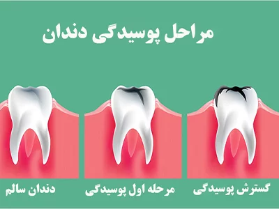 مراحل پوسیدگی دندان