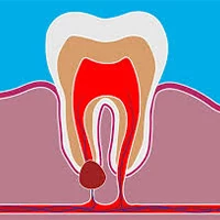 دلیل کیست دندان