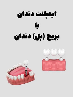 مزایا و معایب ایمپلنت و بریج