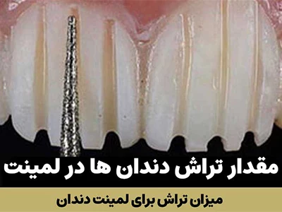 تراش دندان برای لمینت