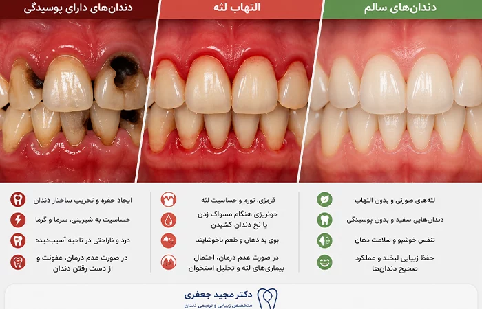 شرایطی که قبل از انجام لمینت دیجیتال باید درمان شوند