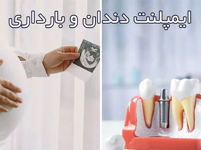 ایمپلنت و بارداری